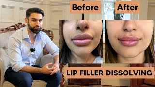 Dissolving Lip Filler  Amazing Results [upl. by Ahsekel488]