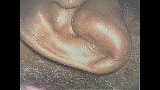 Treatment of Auricular Hematoma [upl. by Rehpotsrihc]