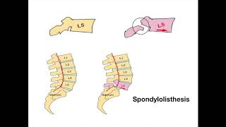 Spondylolisthesis [upl. by Kinemod]