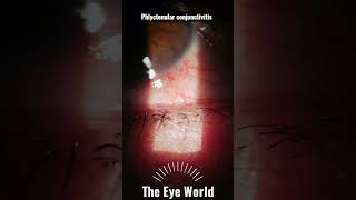 phlyctenular conjunctivitis [upl. by Barth244]