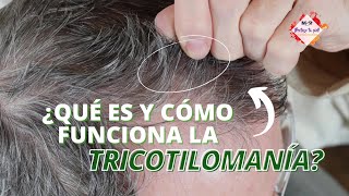 ¿Qué es la tricotilomanía y cómo funciona con la alopecia  ExclusivoMSP [upl. by Aufa]