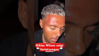 Niklas Wilson Sommer zeigt seine Verletzungen nach Angriff 😱🩸 [upl. by Benny388]