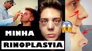 VLOG  MINHA RINOPLASTIA CIRURGIA NO NARIZ  PÓS OPERATÓRIO 24 [upl. by Alyose]