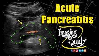 Acute Pancreatitis  Ultrasound  Case 195 [upl. by Zerline]