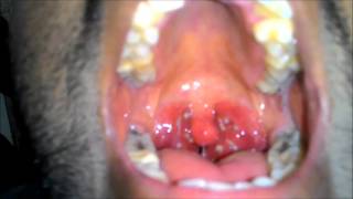 Acute Tonsillitis with Tonsillar exudates [upl. by Sitsuj]