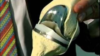 Knee Minimally Invasive Total Knee Replacement Surgery Part 1 [upl. by Rubens]