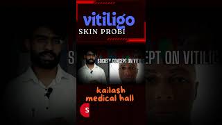 Vitiligo fact Nepali 2024 [upl. by Sheena]