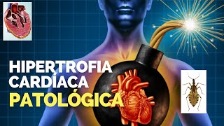 HIPERTROFIA CARDÍACA DO TIPO PATOLÓGICA  CARDIOMEGALIA [upl. by Dinsmore472]