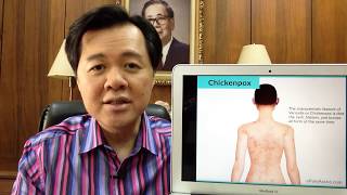 Chicken Pox o Bulutong Tubig  Payo ni Dr Willie Ong 100 [upl. by Joanna]