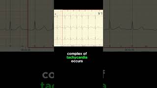 FOCAL ATRIAL TACHYCARDIA ECG EXAMPLE [upl. by Xet]