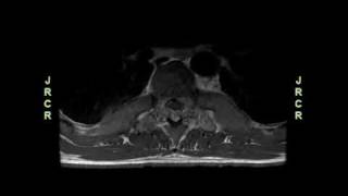 Cord Compression due to Extramedullary Hematopoiesis in an Adolescent with Beta Thalassemia Major [upl. by Aihsyak]