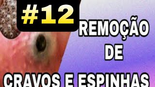 TIRANDO CRAVOS DO ROSTO 2022  SATISFATÓRIO blackheads 12 [upl. by Chappie290]