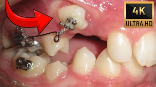 🔥Unexpected orthodontic impaction🔥Timelapse of BRACES in 4K [upl. by Eliezer]