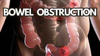 Bowel Obstruction in Seniors What You Need to Know for a Healthier Life [upl. by Kenzie297]