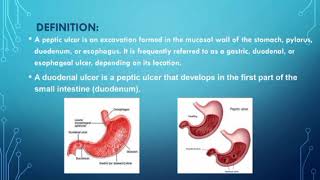 Peptic Ulcer amp Duodenal Ulcer [upl. by Acsecnarf]