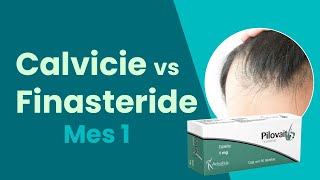 REMEDIO CONTRA LA CALVICIE  ALOPECIA ANDROGÉNICA  FINASTERIDE [upl. by Stanislaw353]