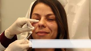 Restylane to the Tear Troughs with Colorescience by Dr Butterwick [upl. by Nomahs]