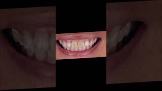 Highlight Composite Veneers for this holiday season [upl. by Sunshine]