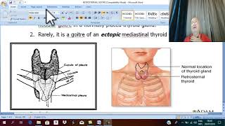 Thyroid Disorders in English 9 Retrosternal Goiter   by Dr wahdan [upl. by Priest]