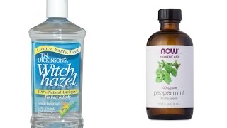 Starter Locs  How to Clean Your Scalp with Witch Hazel [upl. by Emelun]