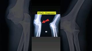 Fracture amp Dislocation Elbow joint Xray xray shorts [upl. by Otsuaf]