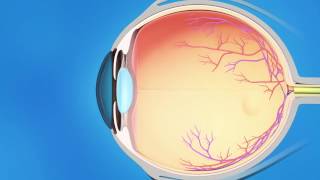 Cyclophotocoagulation CPC for Glaucoma [upl. by Dorolisa432]