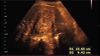 Sonographic prediction of a large intramural fibroid [upl. by Nitsugua]