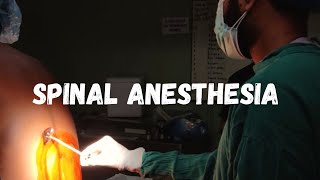 How to give spinal anesthesia  LEARN IN 1 MINUTE [upl. by Mauve]