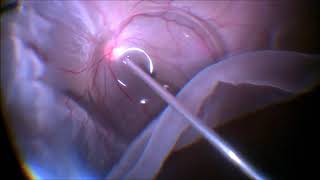 Vitrectomy for Giant Retinal Tear  GRT  Dr Manish Nagpal [upl. by Gustafson346]