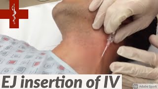 How to do an EJ IV insertion [upl. by Frasch460]