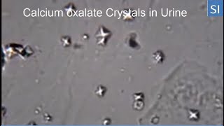 calcium oxalate crystals in urine [upl. by Nylitak666]