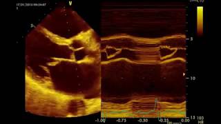 Insuffisance mitrale Sévère par rupture de cordagequotMitral Prolapsequot القصور التاجي الحاد [upl. by Anahsit864]