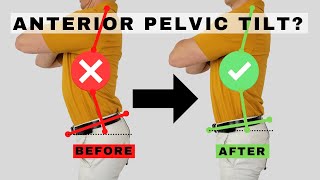 How to Fix Anterior Pelvic Tilt  Dr Jon Saunders [upl. by Eedahs36]