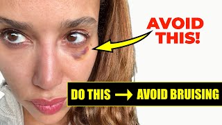 How to Prevent Bruising from Botox and Filler DO THIS Before you get Facial Injections [upl. by Dougal836]