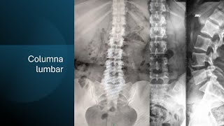 Rx de columna lumbar [upl. by Nnylrebma]