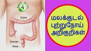 மலக்குடல் புற்றுநோய் காரணமும் அறிகுறியும் symptoms colorectal cancer in tamil [upl. by Sansone]