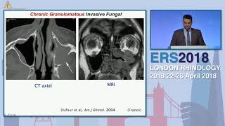 ERS London 2018 Chronic Invasive Fungal Sinus Disease  Evolving Techniques Islam Herzallah [upl. by Etezzil]