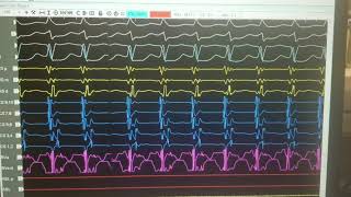 SVT differentiating AVNRT VS AVRT VS ATRIAL TACH [upl. by Addis]