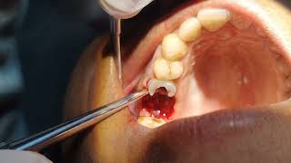 Crown Broke During Extraction How to Extract Rest of The Root Pieces [upl. by Enelak]