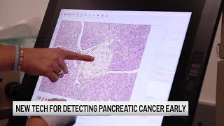 Detecting pancreatic cancer earlier than ever before [upl. by Saphra115]