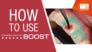 How to Mix and Apply Opalescence™ Boost™ InOffice Medical Tooth Whitening [upl. by Assilym]