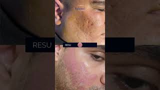 Dermabrasion  Noninvasive Procedure for Acne Scars  Dr Kamal [upl. by Azpurua]