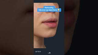 ASMR Lip Injections Realistic amp Relaxing [upl. by Janey]