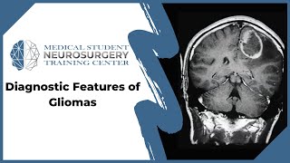 Diagnostic Features of Gliomas [upl. by Kcam]