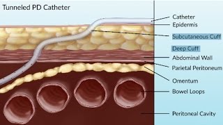 Complications of Peritoneal Dialysis by S Su  OPENPediatrics [upl. by Einnel174]