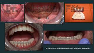 Proteza pe implant dentar  Dr Fatu [upl. by Alegnat]