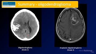 Emergency Imaging of Brain Tumors Oligodendrogliomas amp Others [upl. by Leihcim323]