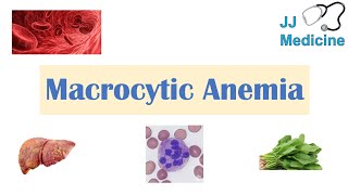 Macrocytic Anemia  Megaloblastic vs NonMegaloblastic  Approach amp Causes [upl. by Sherlock]