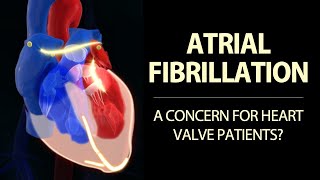 Mitral Stenosis and Aortic Insufficiency Jason C Tippett MD [upl. by Nnylyoj]