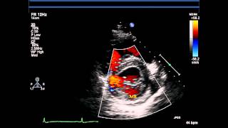 Parasternal Short Axis Views  Echocardiography [upl. by Boynton]